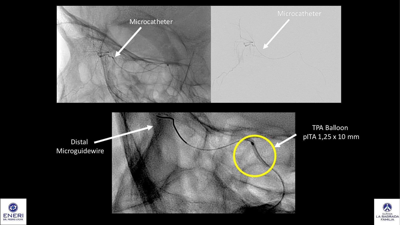 Angiographic view of the microcatheter during ophthalmic artery angioplasty